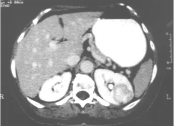 Figure 2 – Computed tomography scan of the abdomen (axial view) shows a solid, approximately 4 cm, left renal mass,  appar-ently restrict to renal parenchyma.