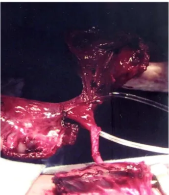 Figure 1 – Incised upper pole. Note the exteriorized catheter through ureteropelvic junction.
