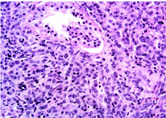 Figure 1 – Neoplasm infiltrating the testis. The seminiferous tubule is involved with non-differentiated neoplastic cells (HE, X250).