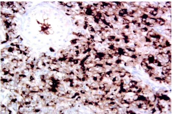 Figure 2 – Positive expression of prostate specific antigen (PSA) by metastatic cells involving a seminiferous tubule (Avidin-biotin peroxidase, anti-PSA antibody 1:20, X250).