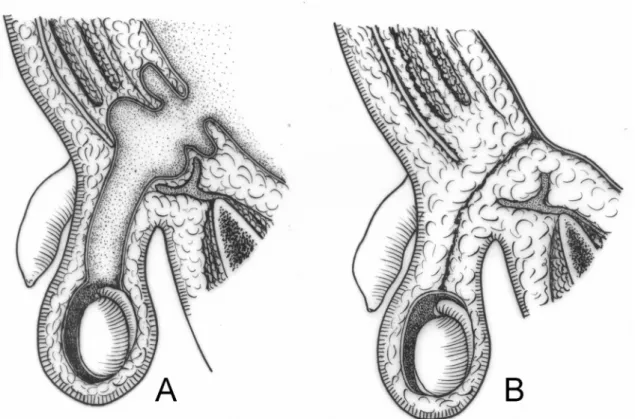 Figure 1 – Schematic drawing demonstrating the persistence of the processus vaginalis (A) and the occluded processus vaginalis (B).