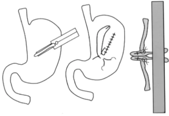 Figure 2 – Schematic drawing of surgical technique in the study group.