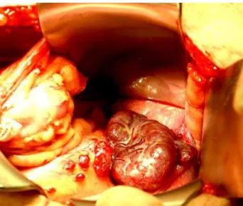 Figure 2 – Intraoperative picture revealing a large bluish-red mass and multiple small implants involving the peritoneum  sur-face of pelvis suggesting ectopic splenic tissue.