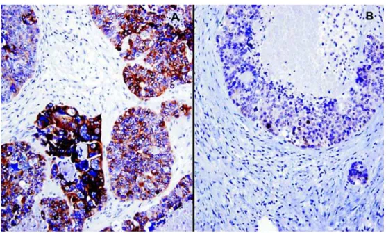 Figure 5 –  Similar to colorectal adenocarcinoma, the urothelial-type adenocarcinoma was diffusely positive for CK20 (A) and CDX2 (B), Immunolabelling, X400.