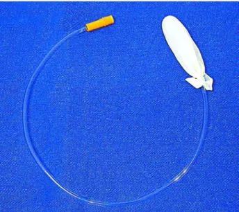 Figure 1 – Gaur’s balloon made of a Nelaton 16F catheter and a finger glove.