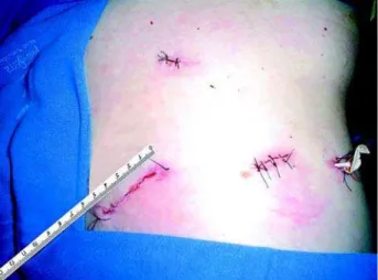 Figure 3 – Final aspect of the incisions. The specimen was re- re-moved by the 5 cm inguinal incision