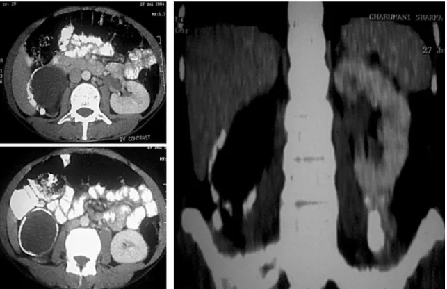 Figure 1 – Kidneys, ureters and bladder X-ray showing eggshell calcification in the region of right kidney.