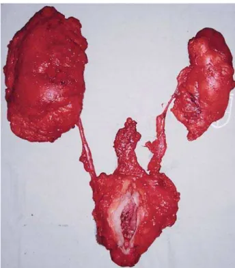 Figure 1 – Surgical specimen shows the complete en bloc re- re-moval of the entire urinary tract and prostate, associated to  ex-tended pelvic lymphadenectomy.