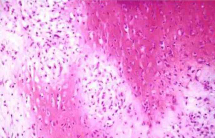 Figure 2 –  Bone differentiation beside areas of poorly differen- differen-tiated carcinoma (HE, X100).