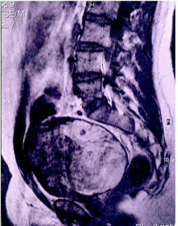 Figure 2 – Histological analysis showing a monotonous pattern of small round cells (HE, X400).