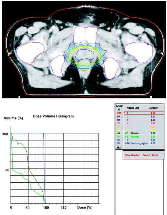 Figure 1 – Prostatic bed outline in axial cut and histogram dose volume of the target volume and risk organs.