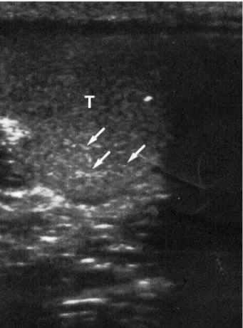 Figure 1 – Ultrasonographic image of a patient with bilateral testicular microlithiasis.