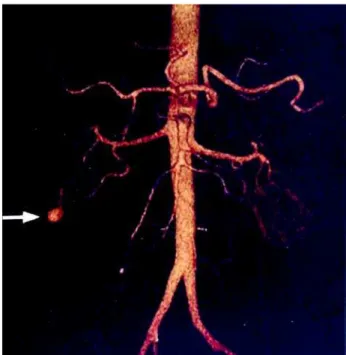 Figure 1 – Inferior pole segmental artery branch with pseudoaneurysm.