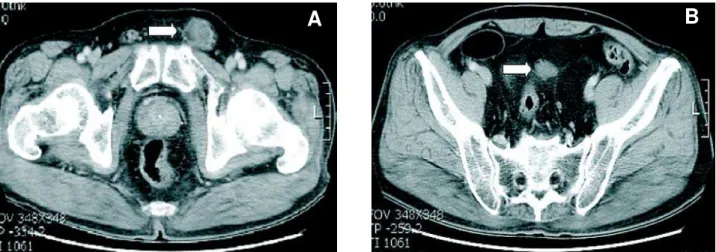 Figure 1 – Contrast-enhanced computed tomography of the pelvis. A) Partially fat containing soft tissue mass (arrow) at the left inguinal area