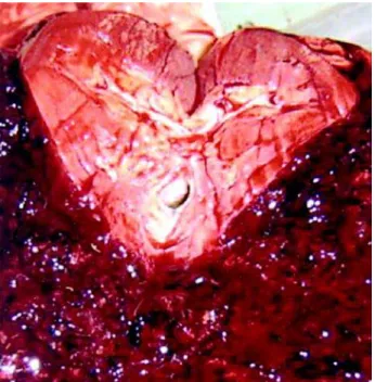 Figure 3 – Histological section demonstrating an angiosarcoma constituted of irregular vascular spaces, anastomosed, covered by cells with voluminous and hyperchromatic nuclei (HE, X200).