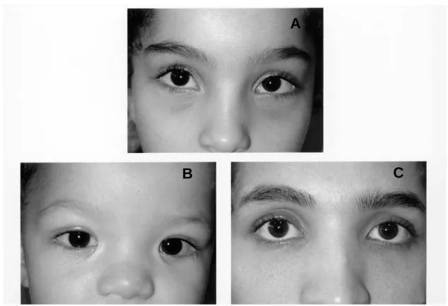 Figure 1 – Faces showing ocular hypertelorism. A) Index case; B) Brother; C) Mother.