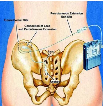 Figure 6 – Stage II sacral neuromodulation- Implantable pulse generator (IPG) unit is placed in the subcutaneous pocket.