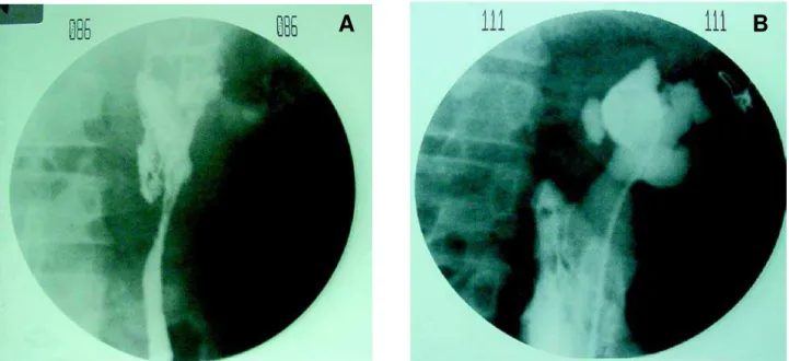 Figure 1 – Intraoperative proximal ureteral perforation (A) treated with double-J stenting (B).