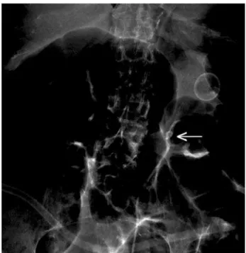 Figure 1 – Knot formation seen on abdominal X-ray (arrow).