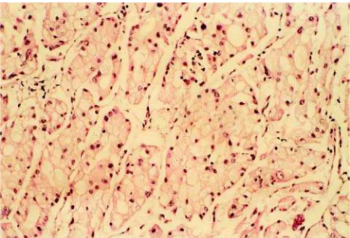 Figure 2 – Renal cell carcinoma with a trabecular and alveolar pattern (HE, X10).