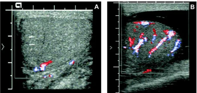 Figure 1  – Testicular ultrasound showing a normal blood flow in the right testicle (A) and increased blood flow in the left testicle (B).