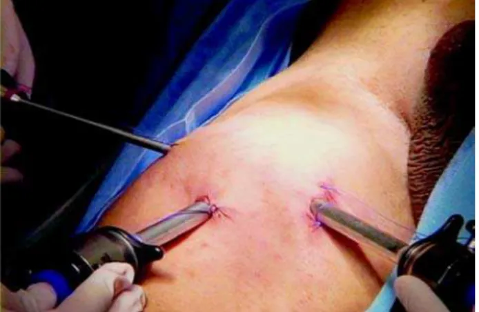 Figure 1 – Trocar disposition for a right member lymphadenectomy. The work space was almost all filled up by the diffusion of gas.