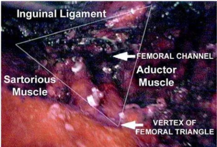 Figure 5 – Aspect of the long saphenous vein in its entrance into the femoral vein.