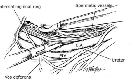 Figure 2 – The spermatic vessels are dissected distally in the direction of the internal inguinal ring (arrow – dotted line)