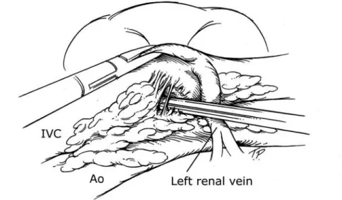 Figure 5 – Interaortocaval dissection is performed with meticulous ligation of all lumbar and lymphatic vessels encountered
