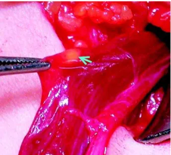 Figure 1 – Intraoperative photograph during orchidopexy for criptorchidism. Arrow and forceps tip marks the well-defined yellow nodule.