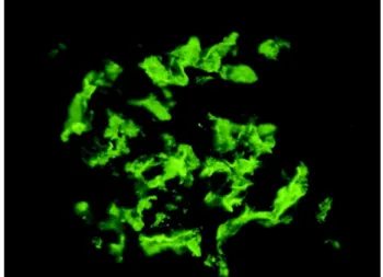 Figure 1 – Histological study showing positive glomerular stain- stain-ing (direct immunofluorescence, X400).