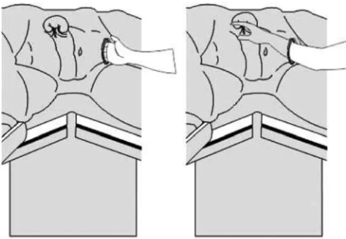 Figure 1 – Modified Pfannenstiel incision. The skin is opened horizontally and the aponeurosis is opened vertically (cruciform incision).