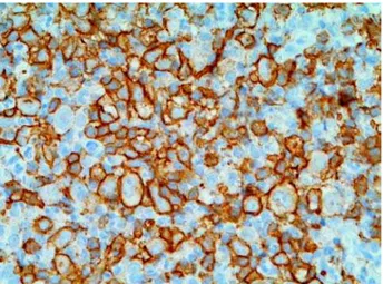 Figure 1 – Photomicrograph showing that the tumor consists of a predominant population of centroblasts and immunoblasts admixed with inflammatory mature cells (HE, X100).