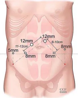 Figure 3 – Intraoperative image at the pelvis with the bladder dropped and prostate (P) and pubic bone (Pb) exposed.