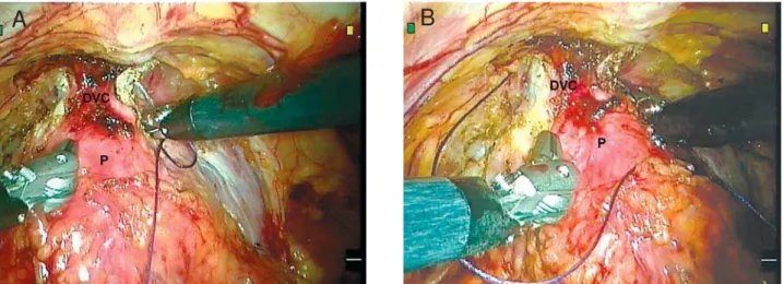 Figure 4  –  A) and B) - Intraoperative images illustrating the control of the dorsal vein complex