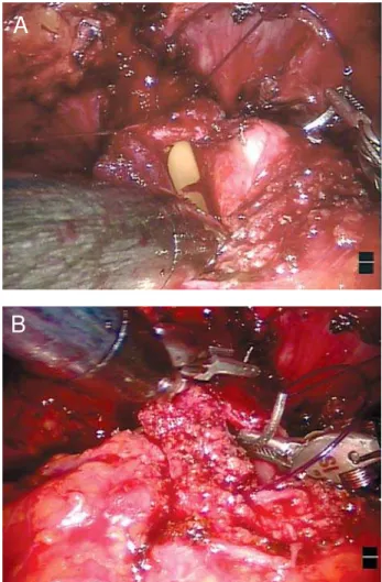 Figure 7 – Bladder neck has been dissected completely and vascular pedicle clipped and ready to be cut as show