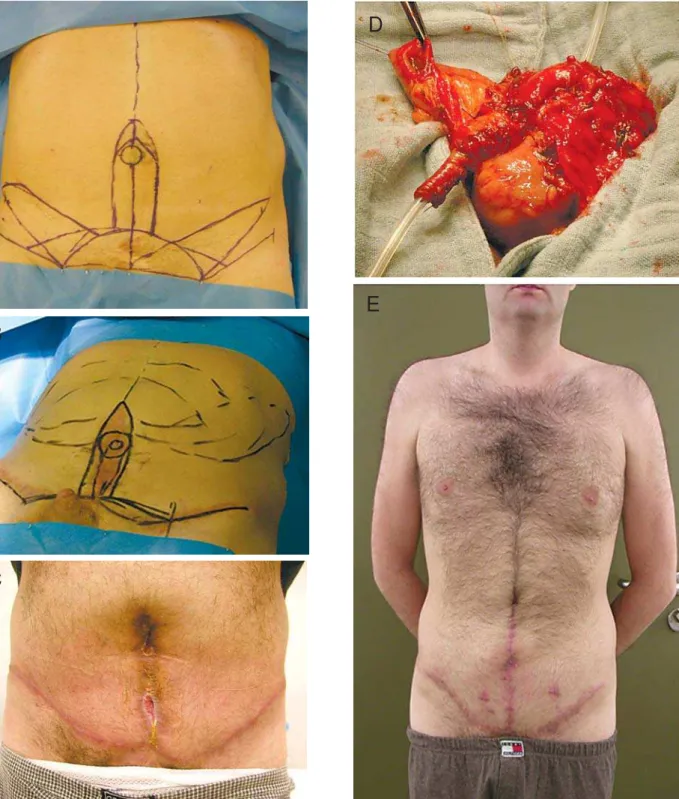 Figure 1 – Construction of a functional neo-umbilicus in a 35-year-old man with previous bladder extrophy treatment