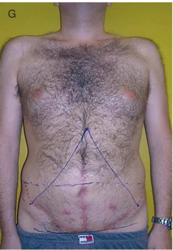 Figure 1 –   continued  –  F) Clinical aspect 6 months after 2nd stage operation: functional result