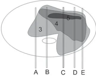 Figure 1 – Differences between the traditional Gleason score (G) and the modified Gleason score in five hypothetical prostatic needle biopsies with prostate cancer.
