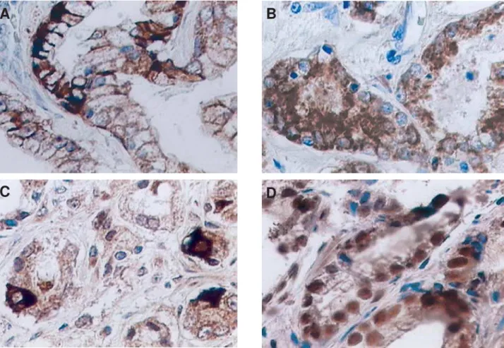 Figure 1 – Prostatic tumor with expression of different immunomarkers. A) Variation in the E-caderin expression, with focal membrane labeling and cytoplasmic pattern
