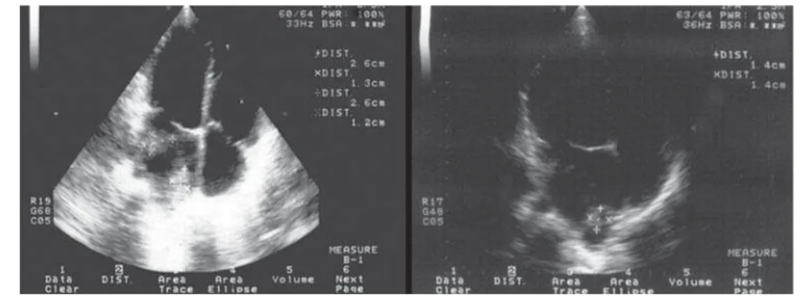 Figure 2 – Echocardiographic evaluation of a cardiac thrombus before and after preoperative chemotherapy: absence of response.