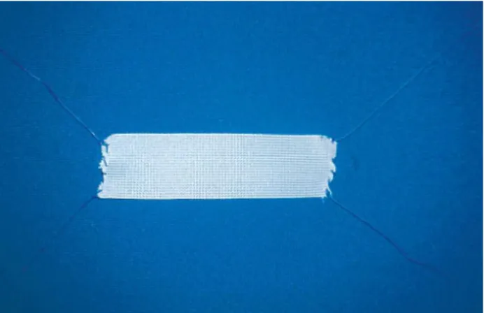 Figure 1 – Polypropylene mesh with poygalactyne-0 thread fixed to the extremities, confectioned by the surgeon.