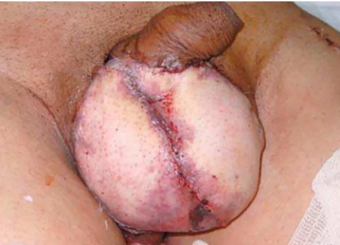 Figure 3 – Postoperative aspect of the reconstructive surgery of the scrotum with thigh skin graft.