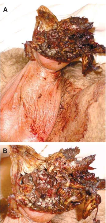 Figure 1 – Patient affected by carcinoma epidermoid of the penis associated to myiasis