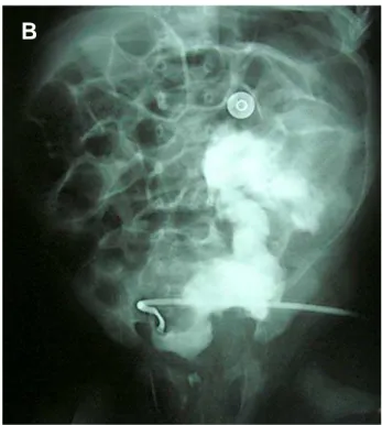 Figure 1 – Voiding cystourethrography of case #1. A)  High- High-grade vesicoureteral reflux on the left side