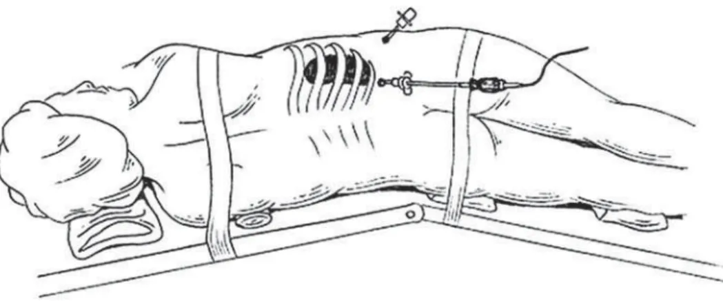Figure 1 – Patient position in operative table for retroperitoneoscopic renal biopsy.