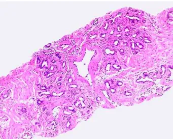 Figure 3 – Partial atrophy (immunohistochemistry: 34âE12).