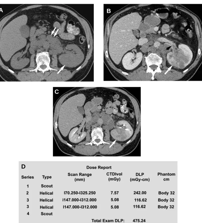 Figure 1 – Axial CT scan of the abdomen showing renal cell carcinoma. A) The tumor is involving the left kidney (arrow) with nodal metastases in the retroperitoneum (double arrow)