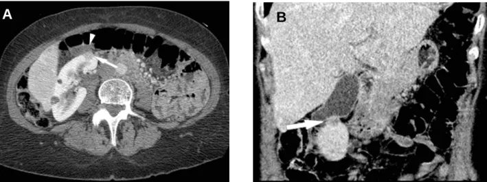 Figure 2 – The axial sections in this case failed to show the gallbladder involvement as clearly as the sagittal reformatted image did