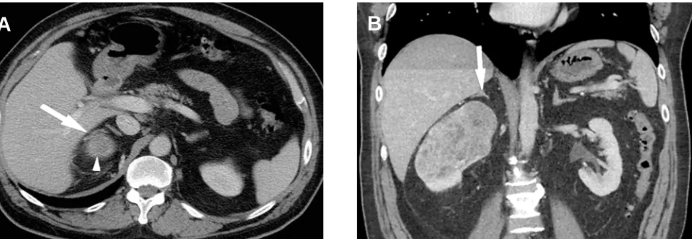 Figure 3 – Noninvolvement of the adrenal shown more clearly on the coronal reformat. A) Axial image through the superior portion of the right kidney illustrating the tumor (arrowhead) in close proximity to the right adrenal gland (arrow)
